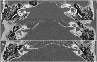 Vestibular dysfunction in lateral semicircular canal dysplasia